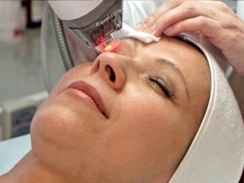 laser skin rejuvenation around the eyes