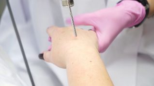 Laser skin rejuvenation of hands